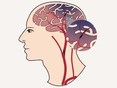 择思达斯：日常脑萎缩有哪些预防措施?